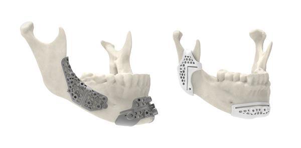 3d-systems-jaw-material-mockup-sls-and-titanium-300ppi.jpg